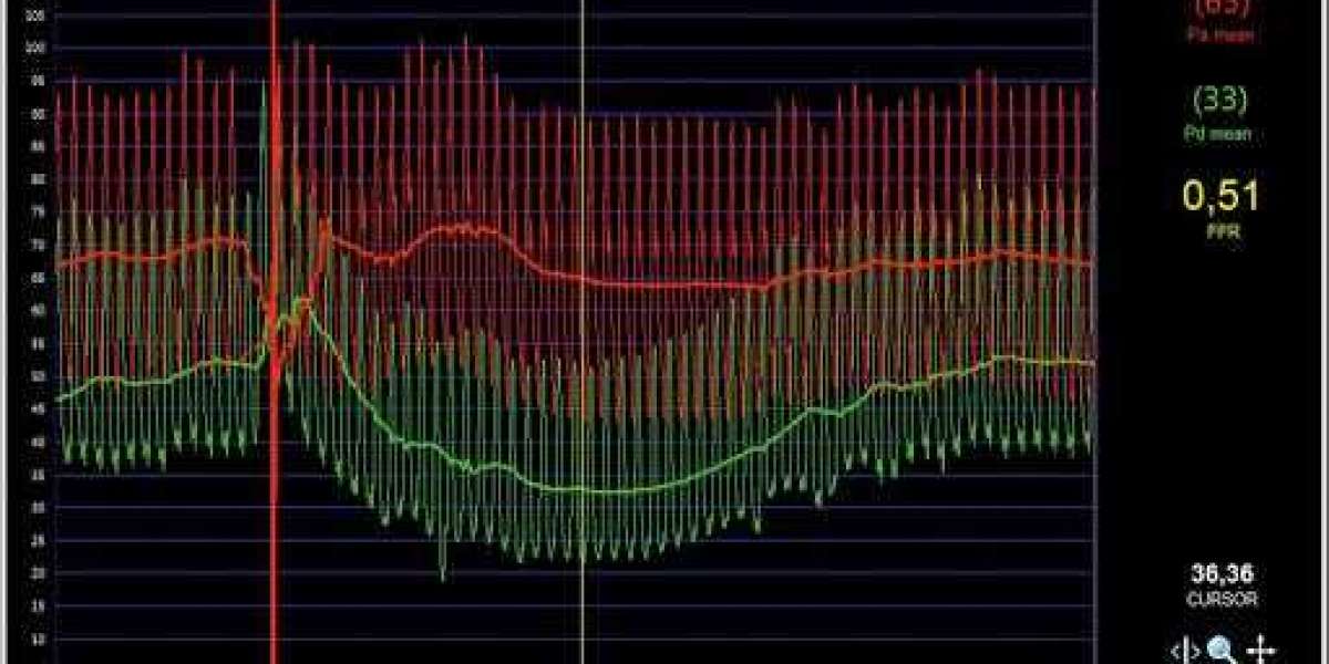 Fractional Flow Reserve Market Strategy, Revenue, Opportunity, Business Segment Overview and Key Trends 2028