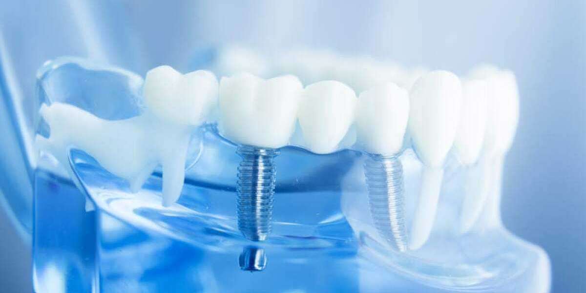 Dental Impression Systems Market Industry Size & Share, Comprehensive Analysis to 2028