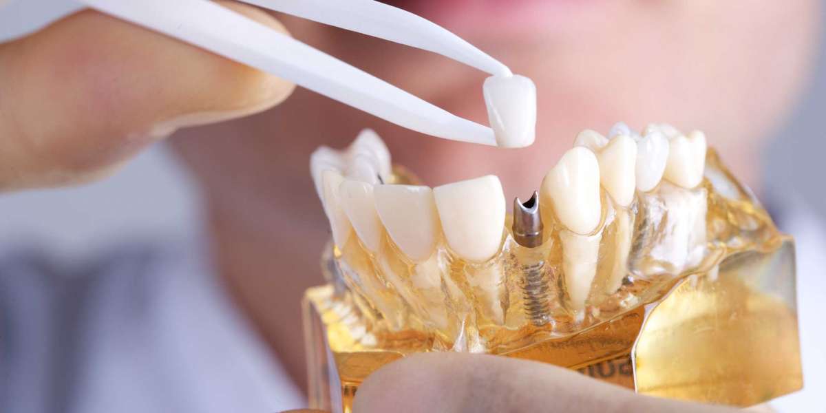 Dental Prosthetics Market In-Depth Analysis by Opportunities, Challenges AND Forecast 2028