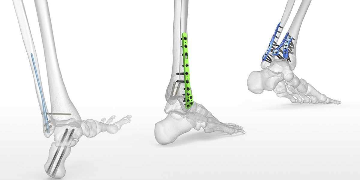 Orthopedic Implant Market Comprehensive Research Study, Trends, Share, Emerging Factors and Future Demands