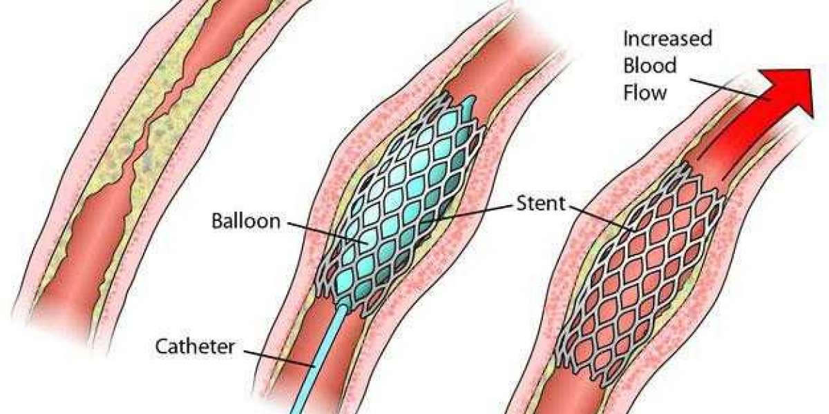 Angiographic Catheters Market Analysis by key Players, Applications, Future Trends and Growth Forecast 2028