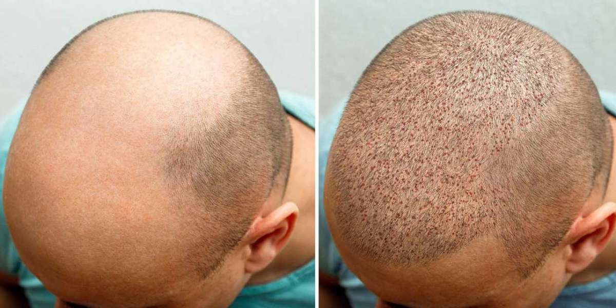 Tatuajes De Pelo En La Cabeza