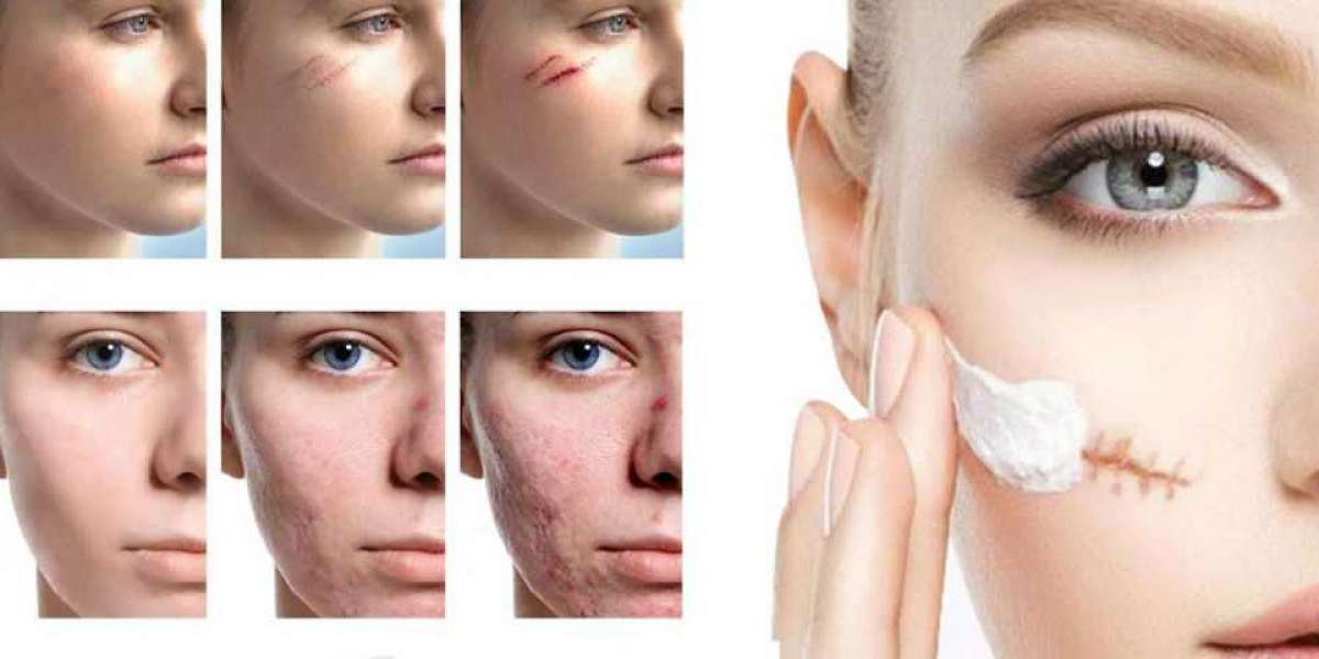 Scar Treatment Market Study with Competitive Landscape, Market Insights and growth Prospects 2028