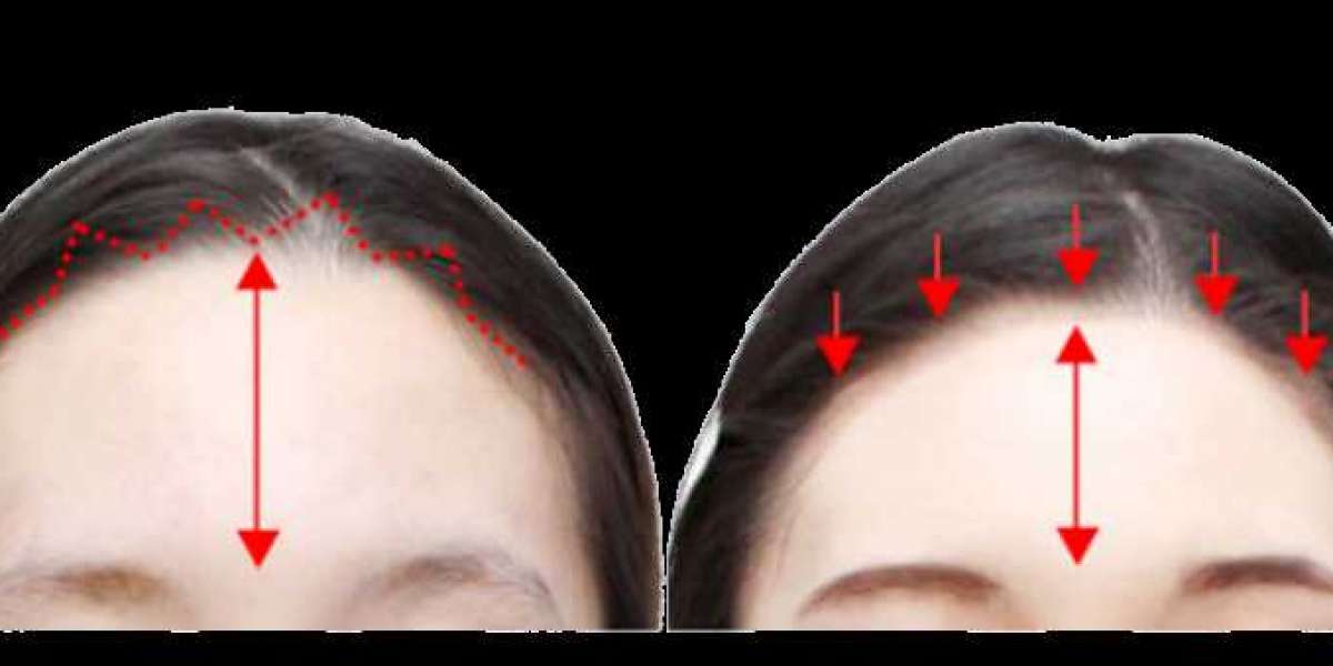 Reducción de la línea del cabello