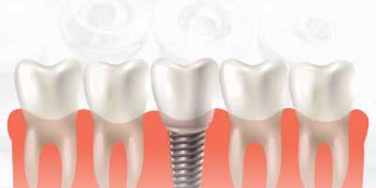 Medical Implants Market Study, New Project Investment and Forecast till 2029