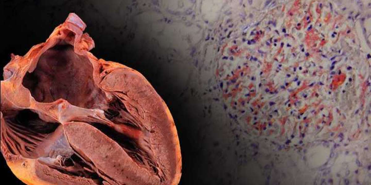 Understanding the Role of Heart Transplantation in Familial Amyloid Cardiomyopathy