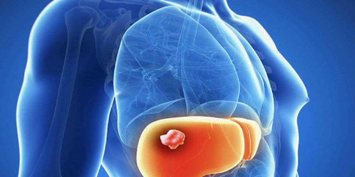 Combination Therapies Involving Hepatocellular Carcinoma Drugs