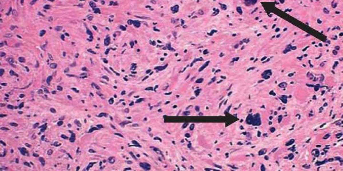 Side Effects of Myeloproliferative Neoplasm Drugs: Management and Prevention