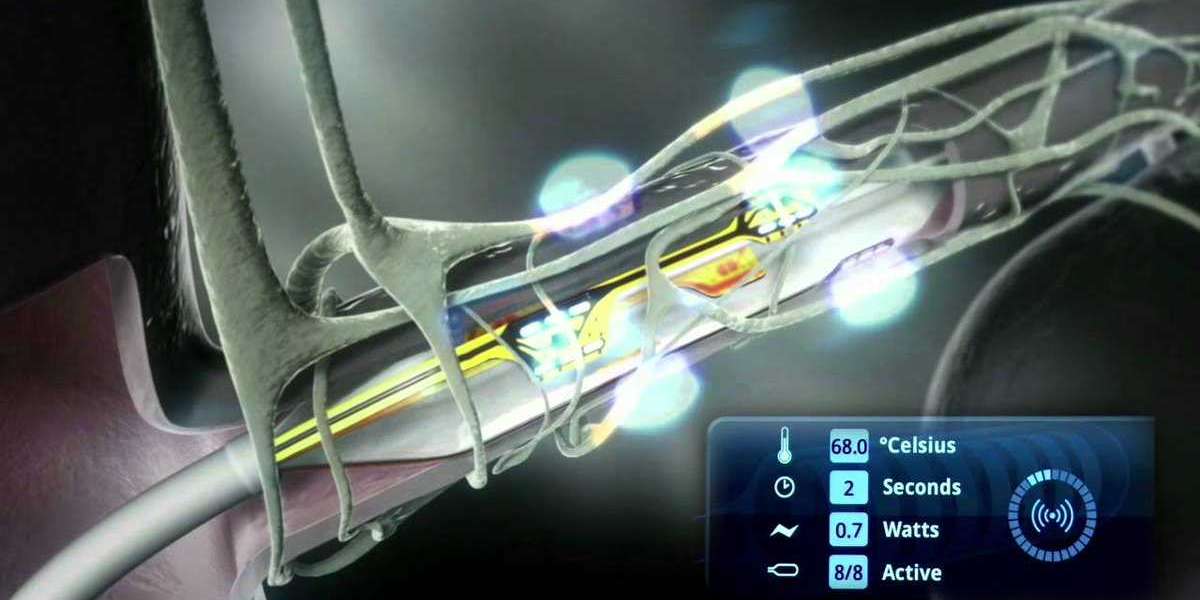 Renal Denervation Devices: Exploring the Role in Cardiovascular Disease Management