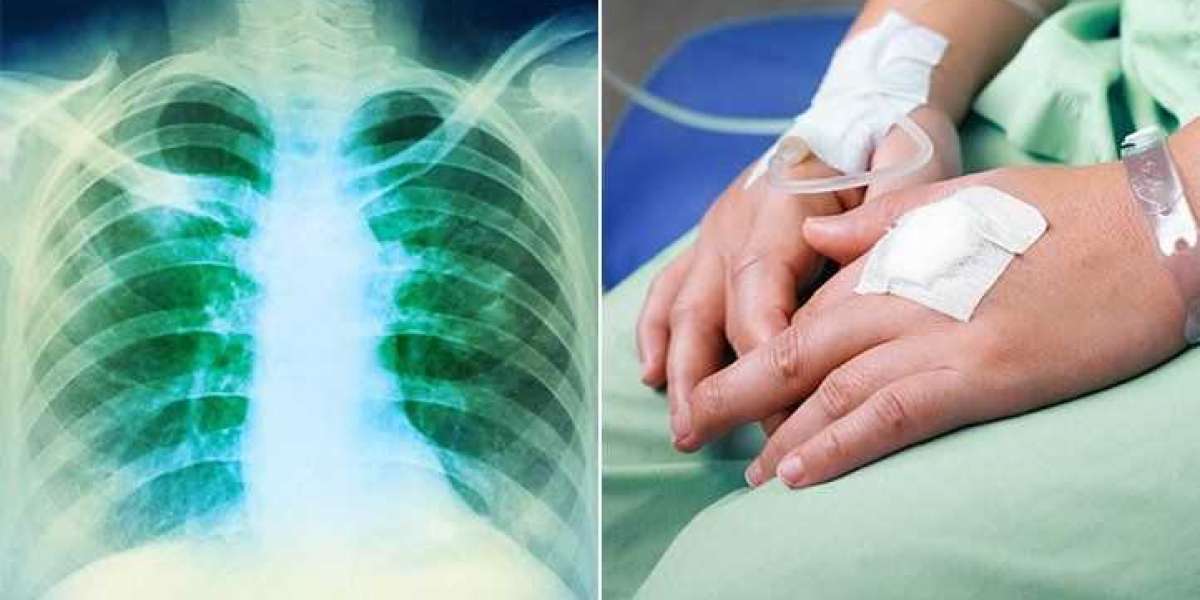 Combination Therapies for Hodgkin's Lymphoma Treatment: Maximizing Treatment Success