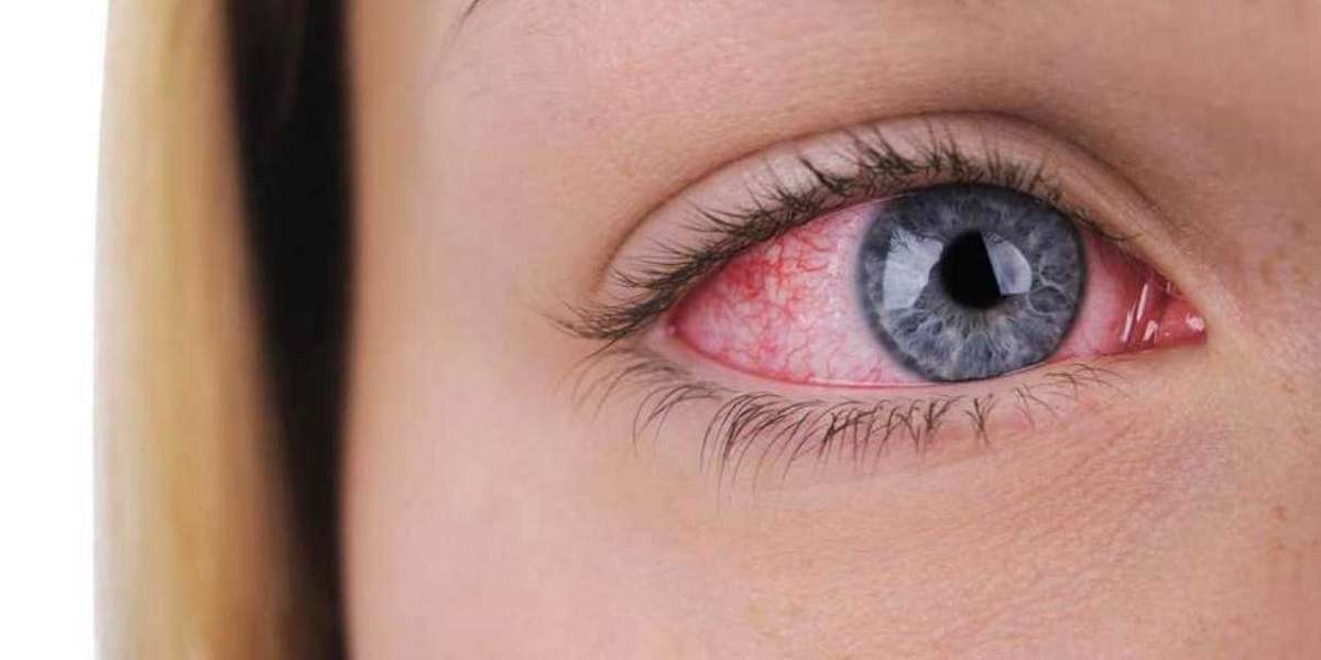 Uveitis Treatment Market Outlook, Market Analysis, Growth and Forecast 2030