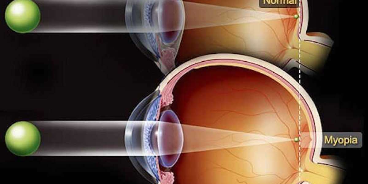 New Advances in Myopia and Presbyopia Treatment: Restoring Clear Vision