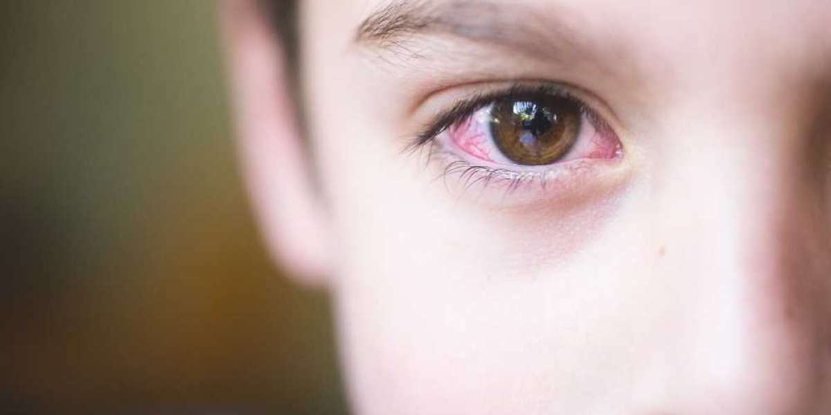 Treating Vernal Keratoconjunctiviti with Anti-inflammatory Medications