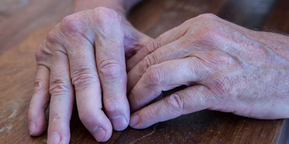 Psoriatic Arthritis Market Is Set To Experience Revolutionary Growth By 2027