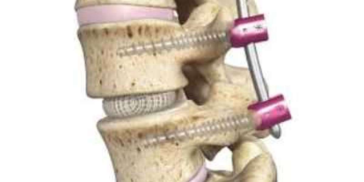 Spinal Interbody Fusion Market: Global Industry Analysis, Size, Share, Growth, Trends, and Forecasts 2023-2030