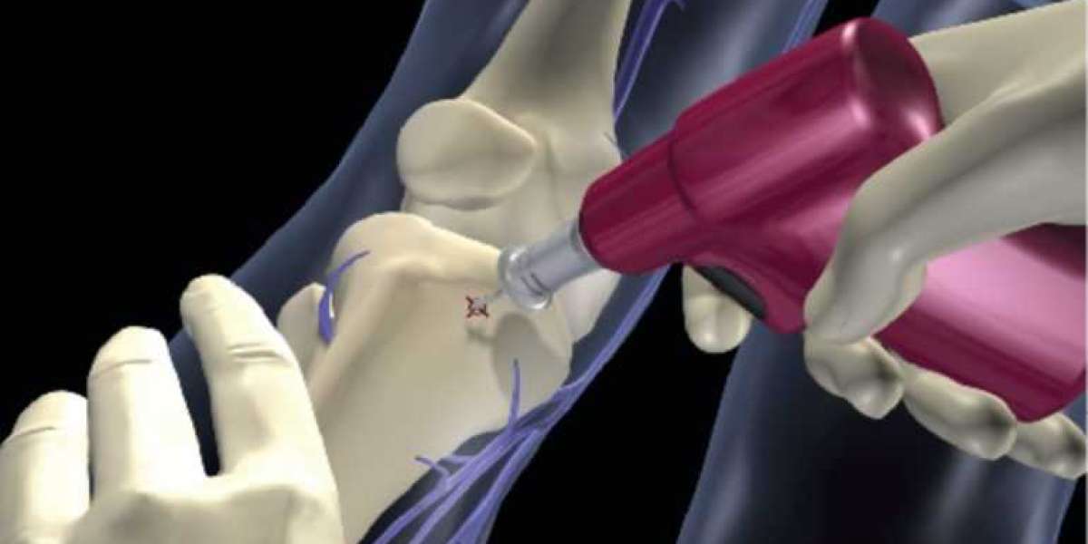 Breaking Barriers: How Intraosseous Infusion Devices are Changing the Game in Medical Treatment