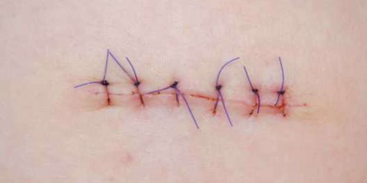 Sutures Market Business Opportunities by Leading Players, Incremental Revenue Growth and Trends Outlook to 2026