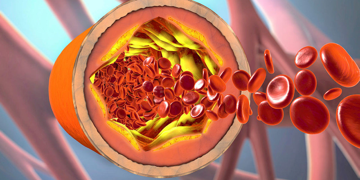 Atherosclerosis Treatment Drugs: Optimizing Drug Delivery for Improved Efficacy