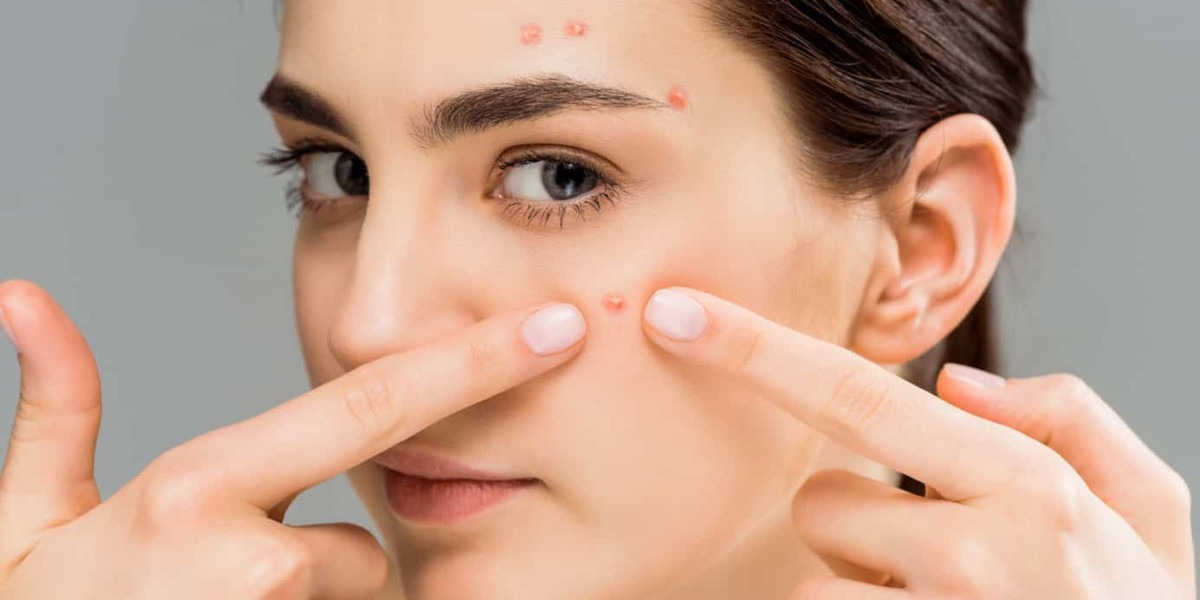 In Addition To Medications, Acne Medication Also Include Treatments And Procedures For Managing And Treating Acne