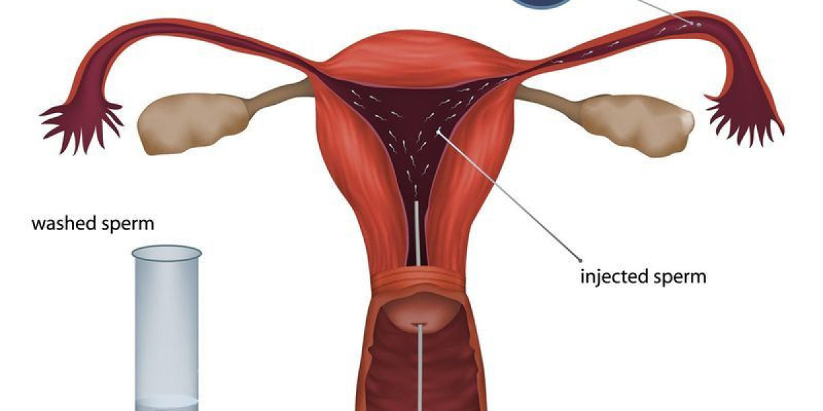 An Artificial Insemination Is A Procedure That Introduces Semen Into A Woman's Vagina Or Cervix By Means Other Than
