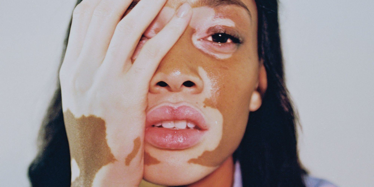 Managing Vitiligo with Cutting-Edge Drugs: Latest Developments and Treatment Strategies