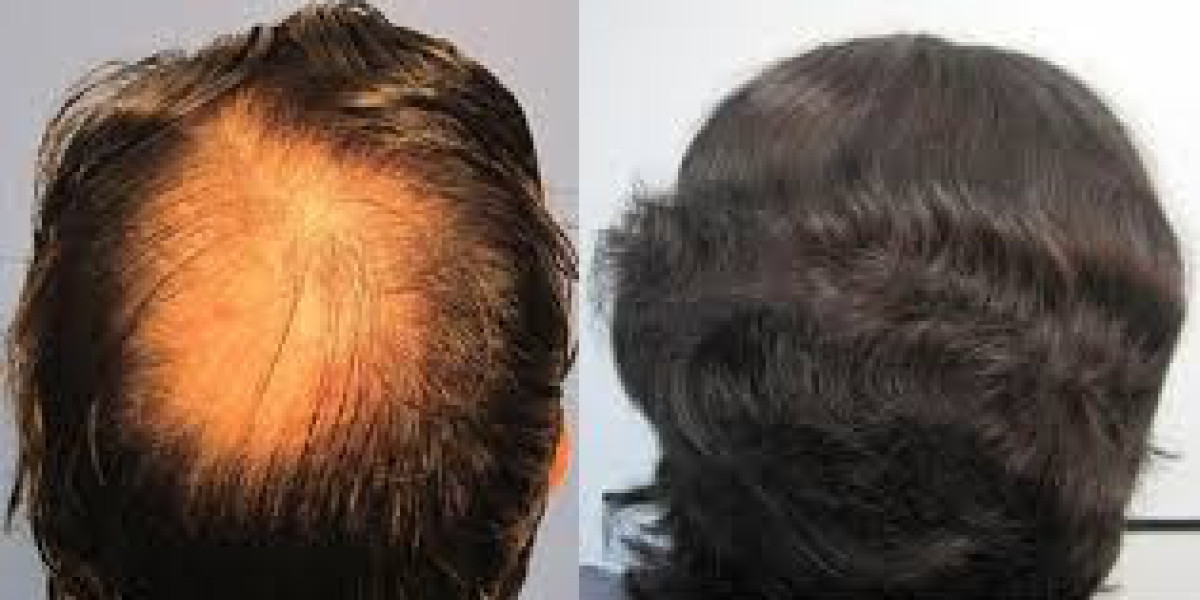 Crown hair transplant refers to the transplantation of hair to the crown area of the scalp, which is the top and back po
