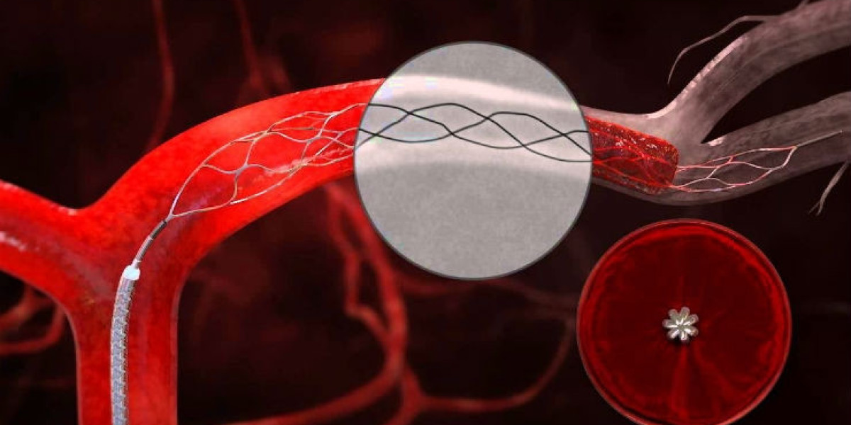 Innovations in Clot Management Devices: Improving Patient Outcomes