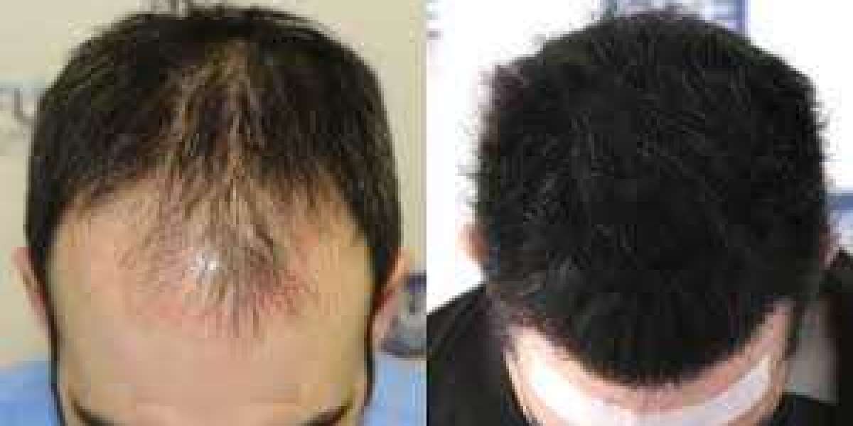 How Many Grafts Required for Hair Transplant?