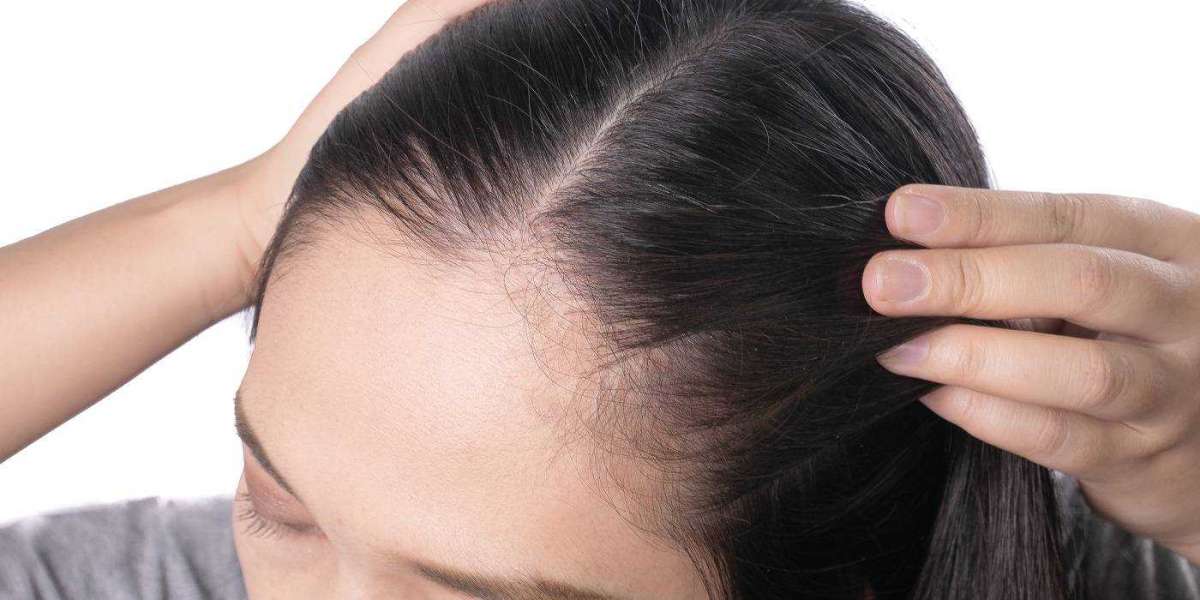 Hair Loss Treatment Is Important For Preventing Or Slowing Down The Loss Of Hair, Restoring Self-Confidence And Self-Est
