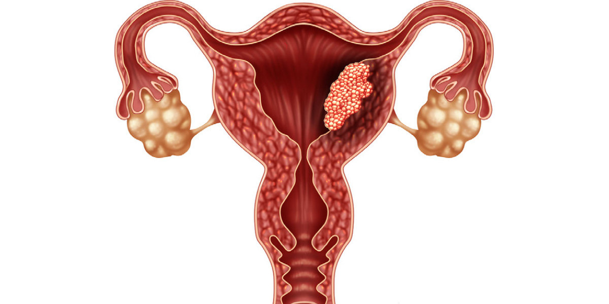 Uterine Fibroid Treatment Devices Provide Numerous Advantages To Women Suffering From Fibroids