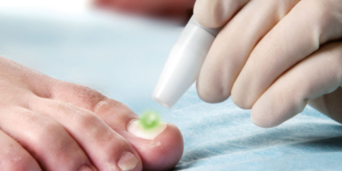 As Medical Research And Technology Advance, New Approaches For Onychomycosis Treatment Are Emerging
