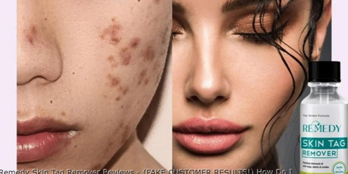 https://www.facebook.com/RemedySkinTagsRemoverReviews/