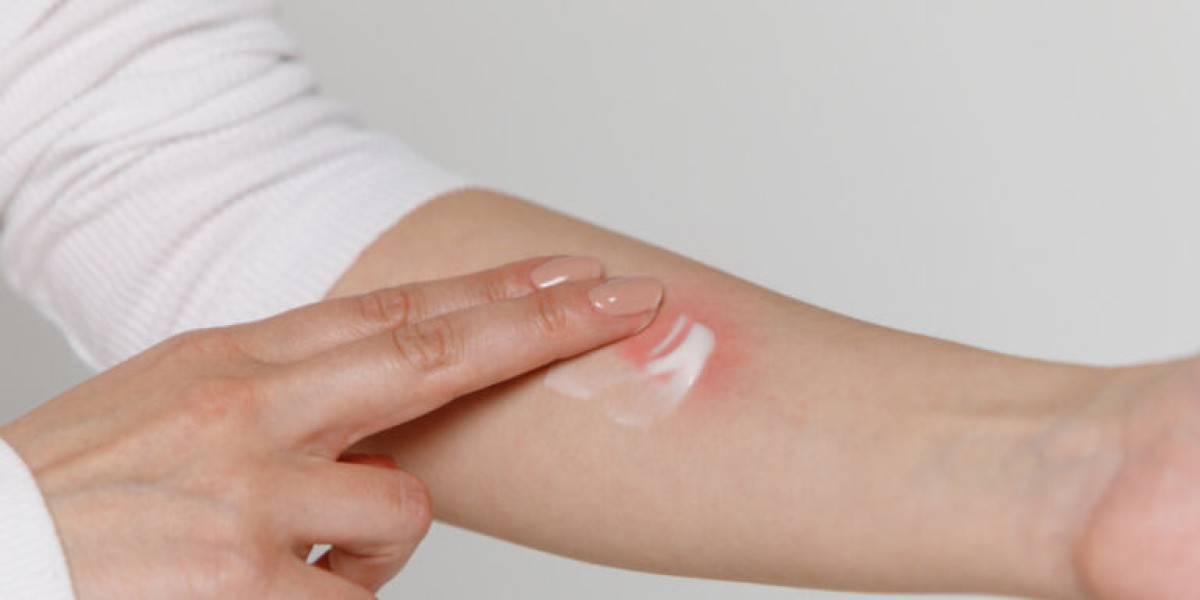 Let’s Know About the Benefits of Burn Ointment?