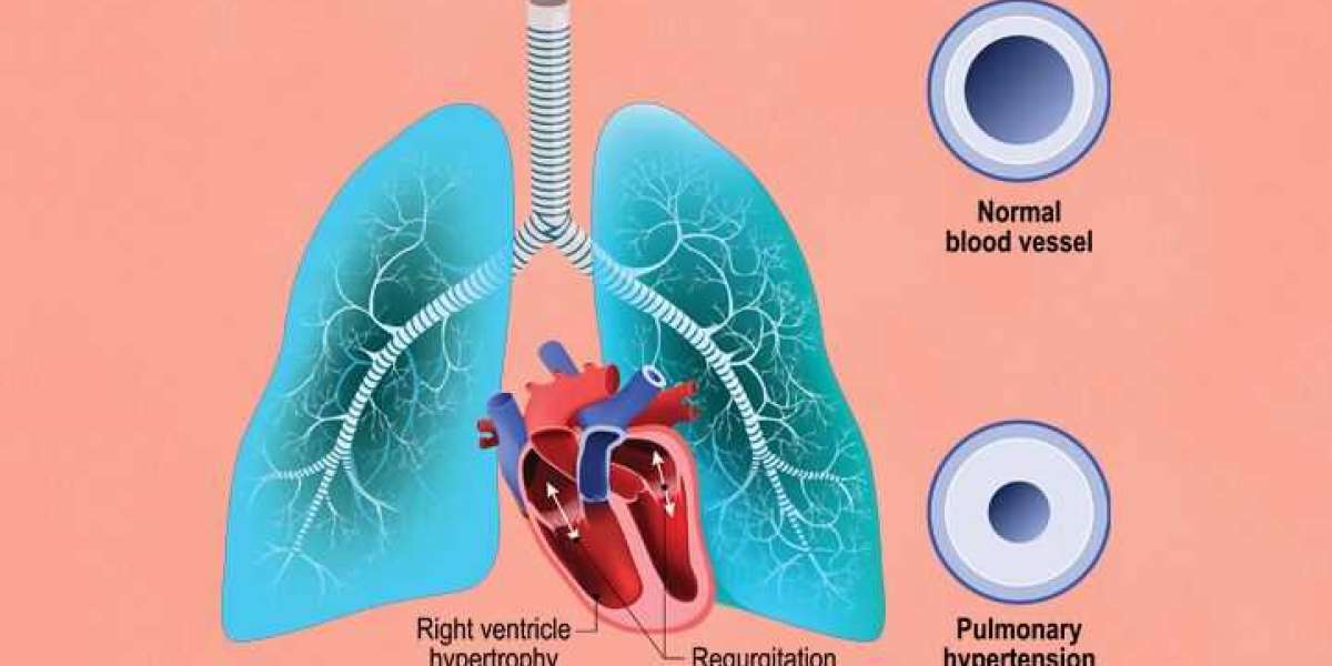 The Pulmonary Arterial Hypertension Drug Is Used To Treat Pulmonary Hypertension (PH) In The Lungs