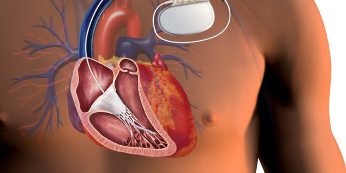 Navigating the Implantable Cardioverter-defibrillators Market: Insights and Analysis