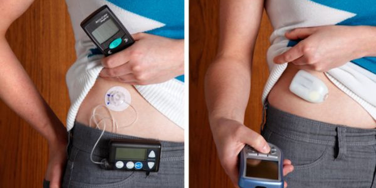 The Most Common Method of Insulin Delivery Devices Is Still a Needle and Syringe Directly Under the Skin