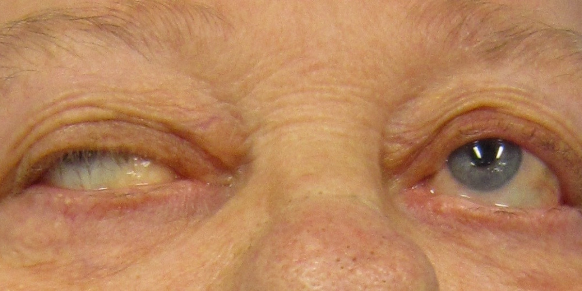 Myasthenia Gravis Market: Epidemiology, Trends, Demand, Share, Size (2023-2033)