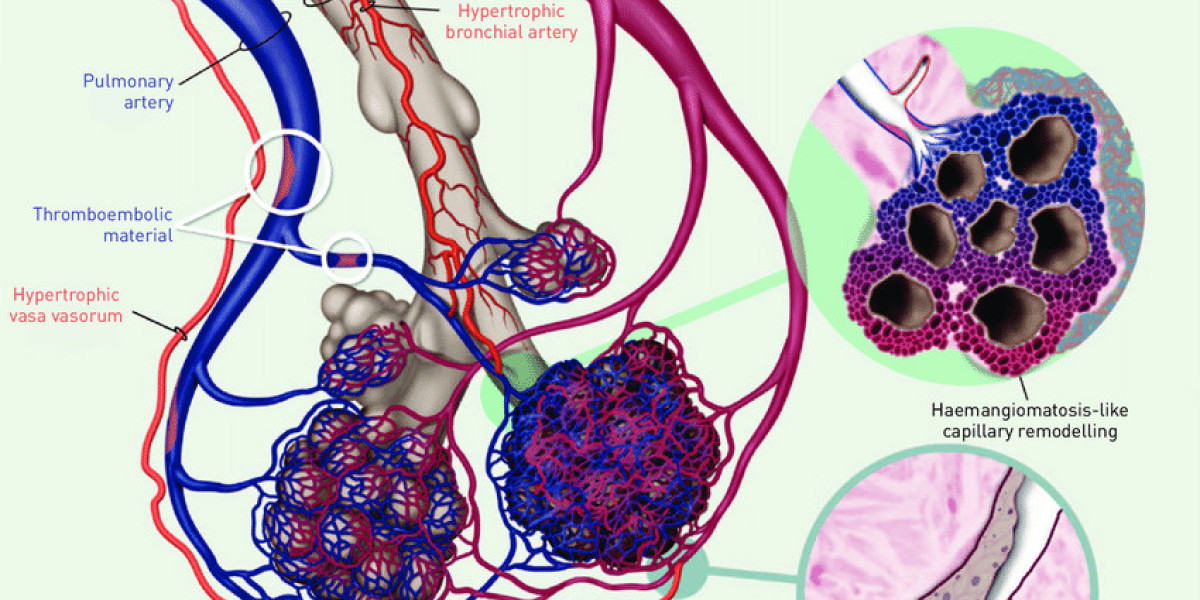 Pulmonary Arterial Hypertension Drug Market Upcoming Trends and Competitive Outlook till 2028