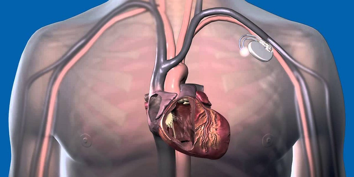 Behind The Pulse: Demystifying Cardiac Pacemakers And Their Implantation Process