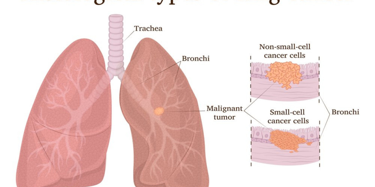 Non-Small Cell Lung Cancer Research: Breakthroughs and Future Directions