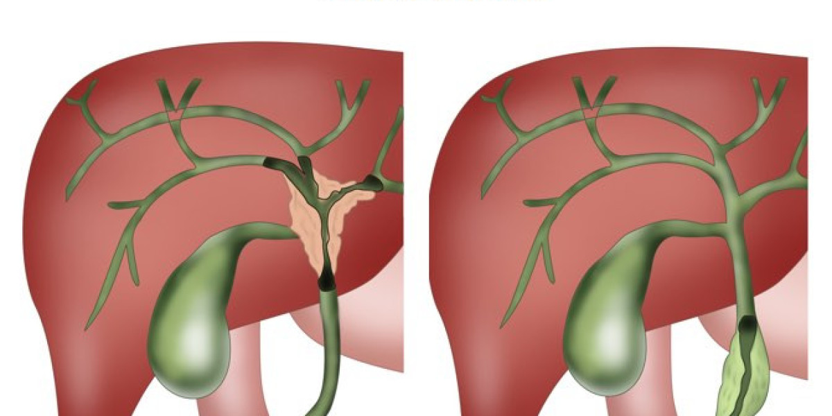 Uncovering the Mystery of Cholangiocarcinoma
