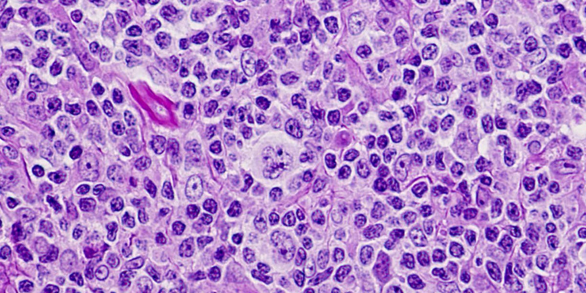 T-Cell Lymphoma: Role Of The Microbiome In Disease Modulation                                                 
