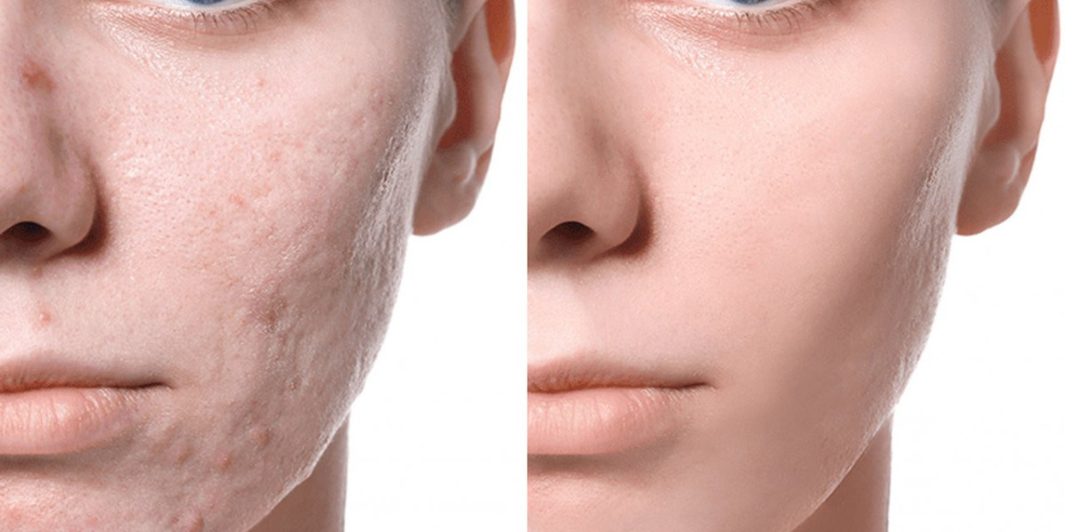 Future Prospects of the Scar Treatment Market: Forecasts and Predictions