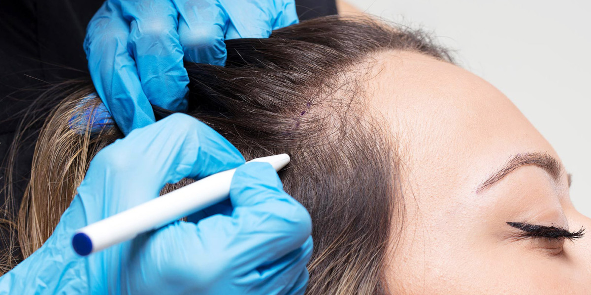 Revolutionizing Hair Loss Treatments: Advances in the Hair Loss Treatment Market