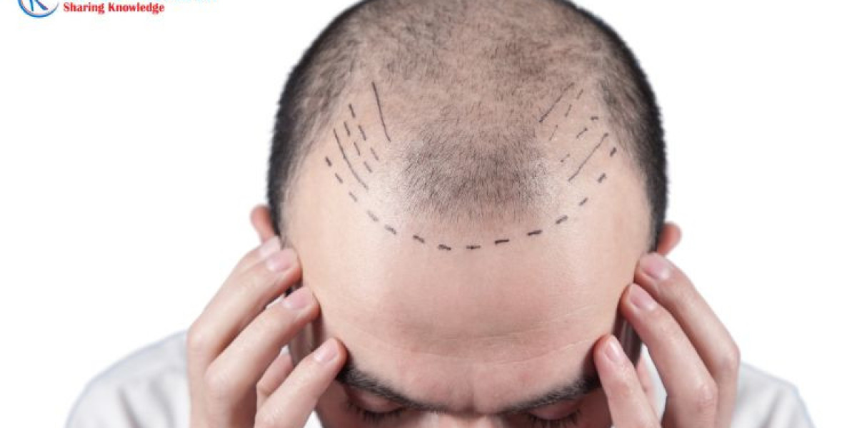 Hair Transplant Market, Global Forecast Report 2023-2028