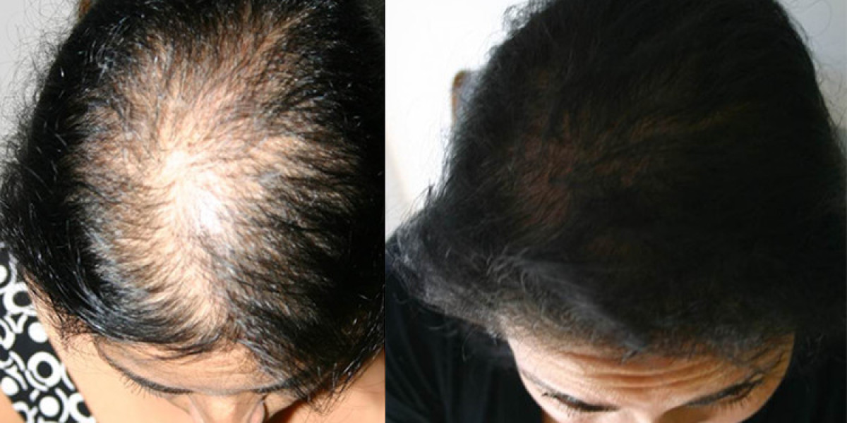 Ladies Hair Thinning Treatment by Hair Transplant
