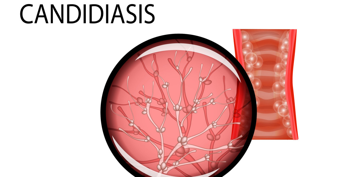 Conquering Candidiasis: Understanding, Treating, and Preventing Fungal Infections