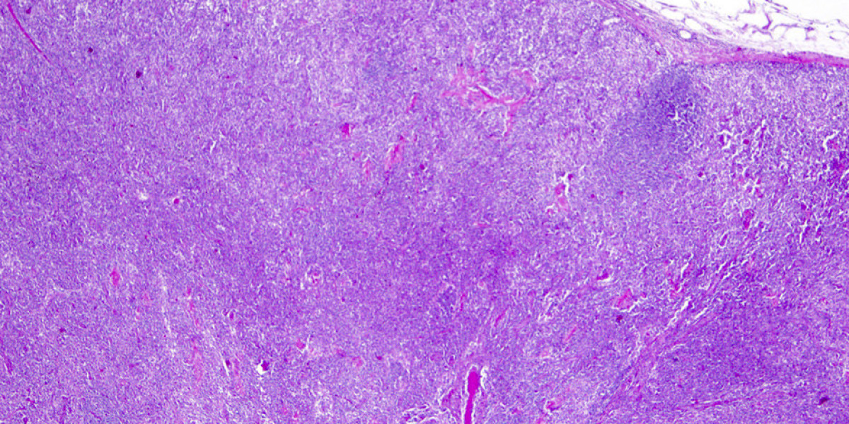 Advances In T-cell Lymphoma Research: Unveiling New Treatment Options