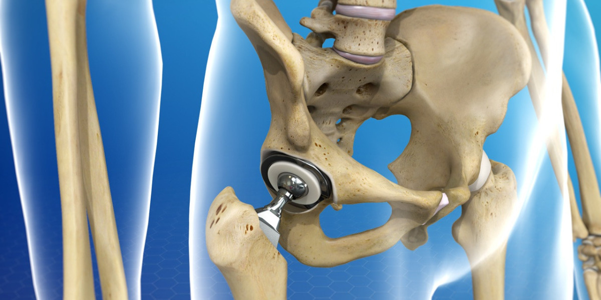Total Knee Arthroplasty: A Surgical Solution For Chronic Knee Pain