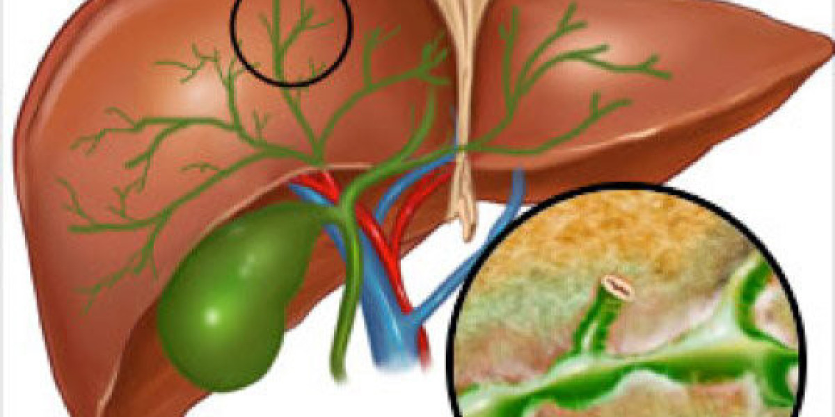 Navigating the Journey: Understanding Primary Sclerosing Cholangitis